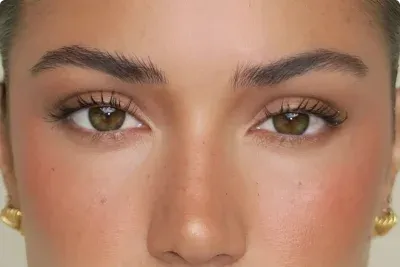 blefaroplastia